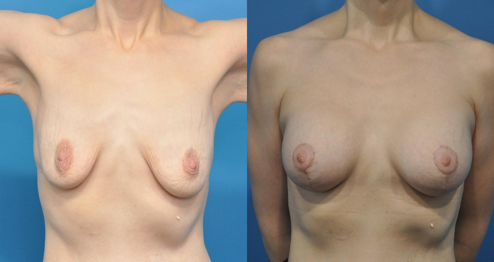 Before & After Breast Augmentation Case 173 View #1 View in North Shore, IL