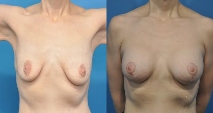 Before & After Breast Augmentation Case 173 View #1 View in Northbrook, IL