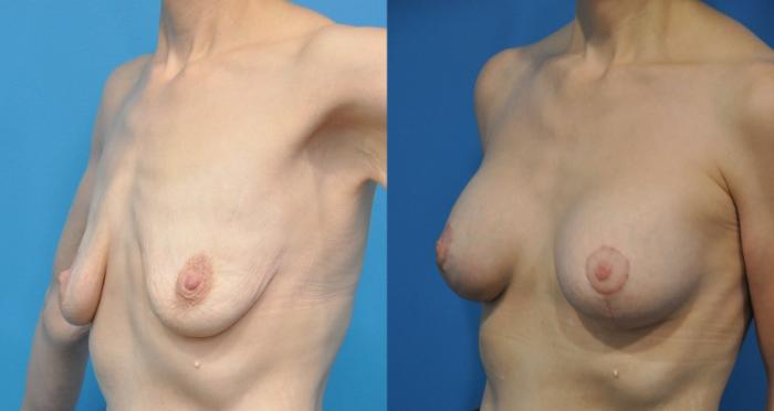 Before & After Breast Augmentation Case 173 View #2 View in North Shore, IL