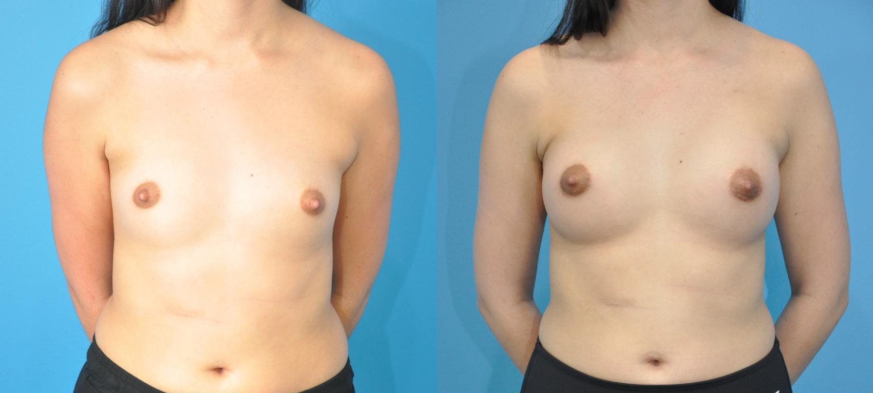 Before & After Breast Augmentation Case 234 View #1 View in North Shore, IL