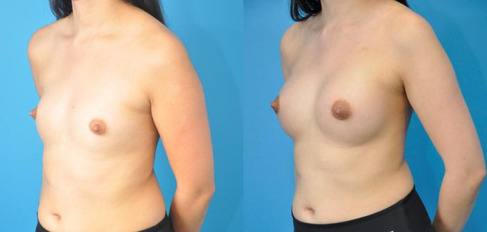 Before & After Breast Augmentation Case 234 View #2 View in Northbrook, IL