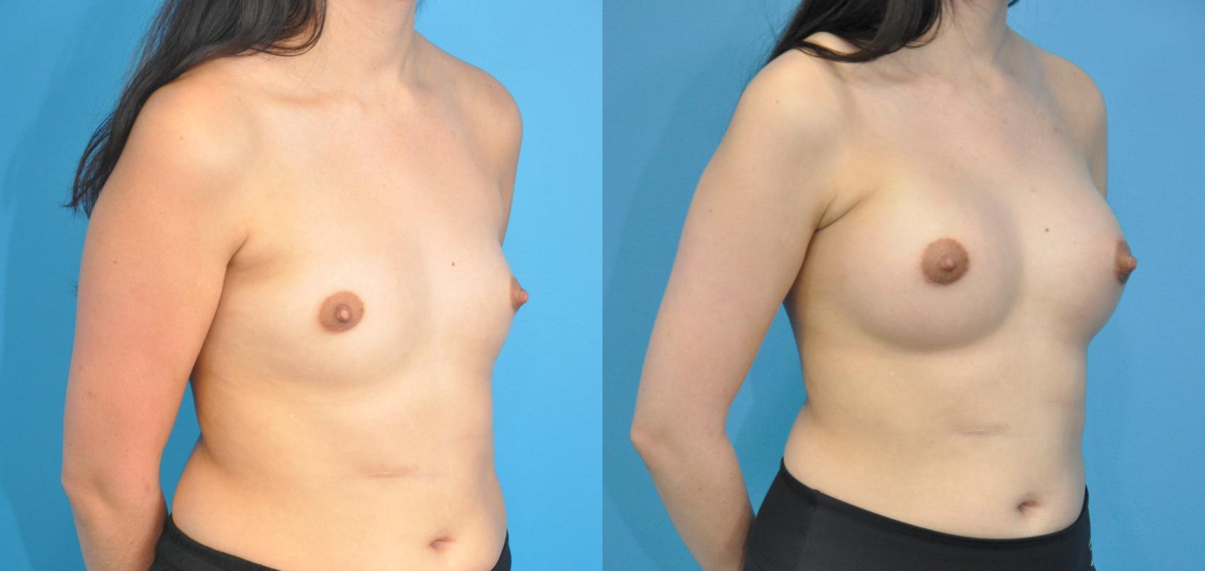 Before & After Breast Augmentation Case 234 View #3 View in Northbrook, IL
