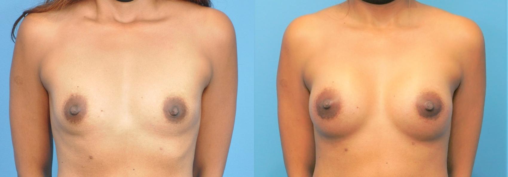 Before & After Breast Augmentation Case 252 View #1 View in Northbrook, IL