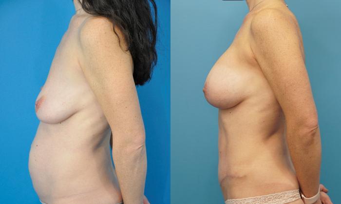 Before & After Breast Augmentation Case 289 Left Side View in North Shore, IL