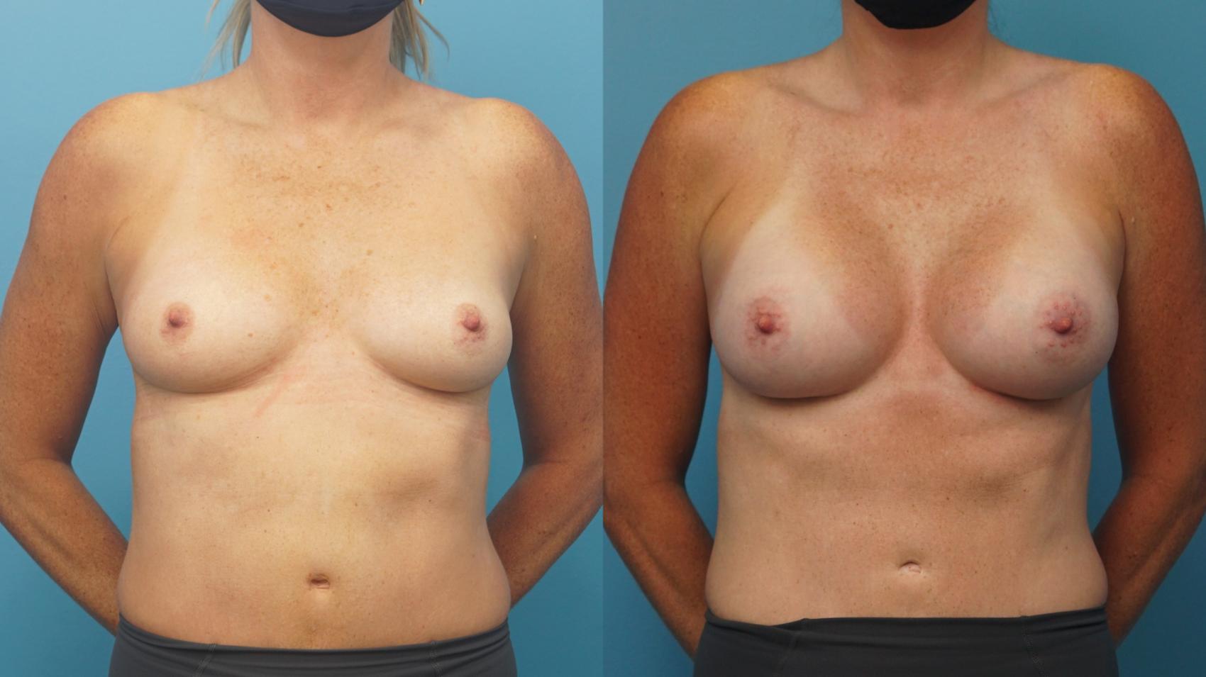 Before & After Breast Augmentation Case 301 View #1 View in North Shore, IL