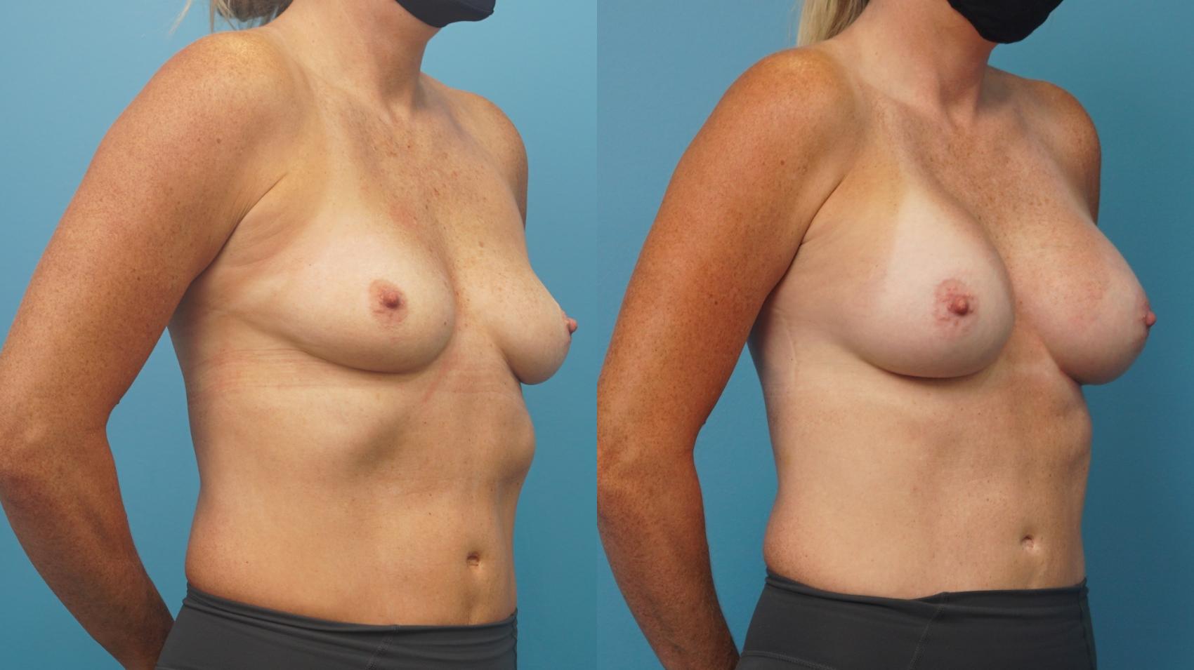 Before & After Breast Augmentation Case 301 View #2 View in Northbrook, IL