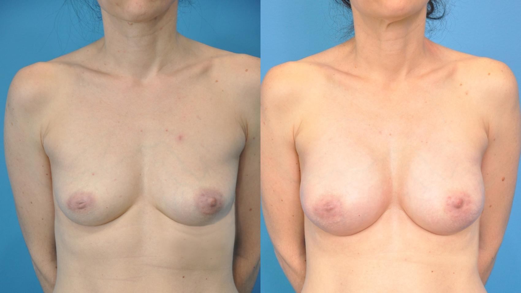 Before & After Breast Augmentation Case 350 Front View in Northbrook, IL
