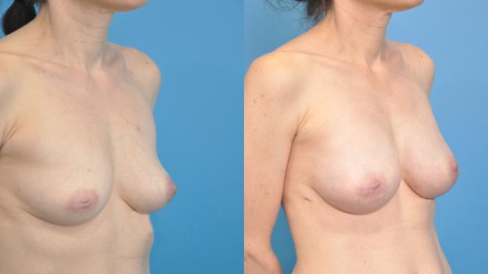 Before & After Breast Augmentation Case 350 Right Oblique View in North Shore, IL