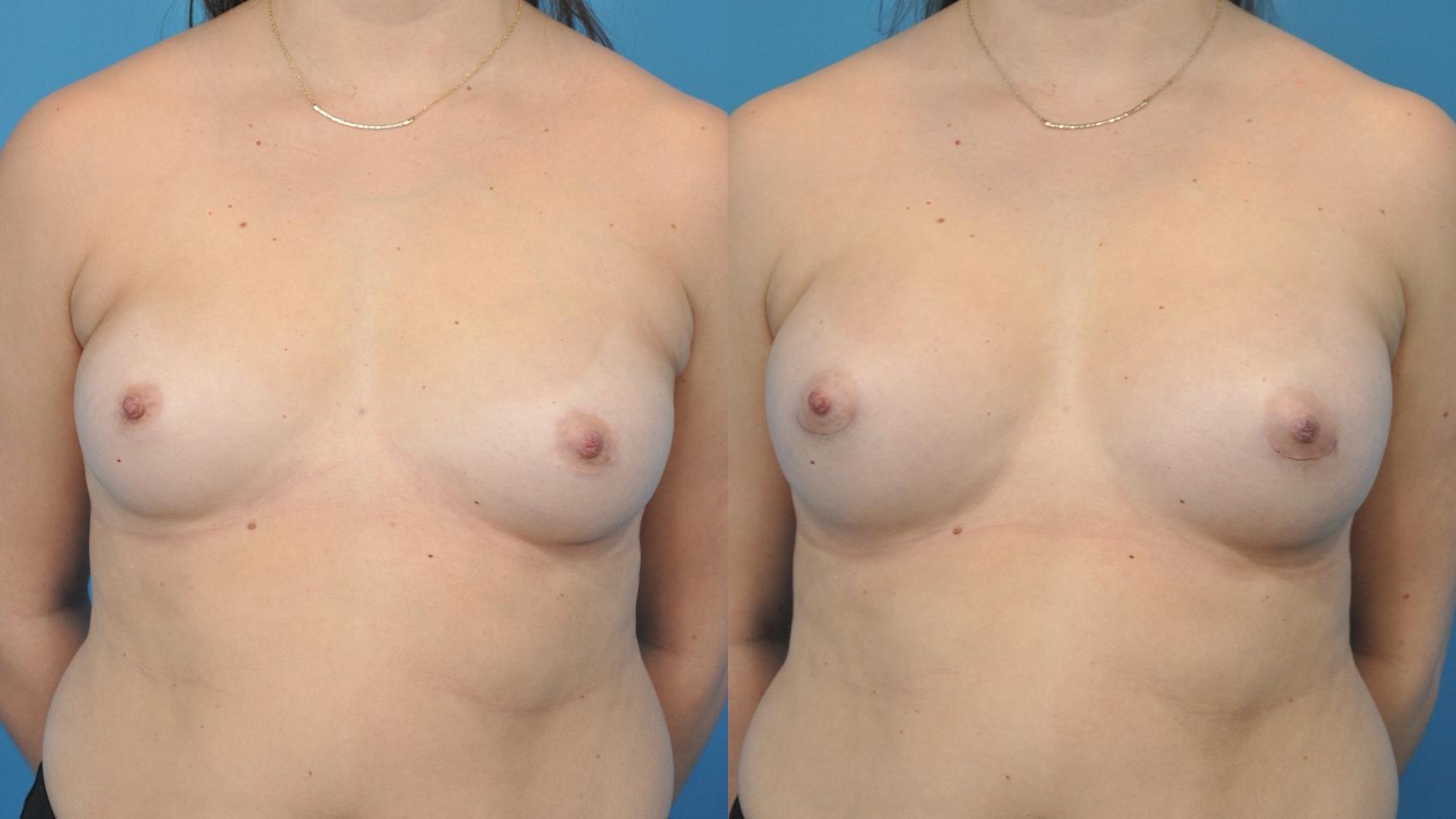 Before & After Breast Augmentation Case 358 Front View in North Shore, IL