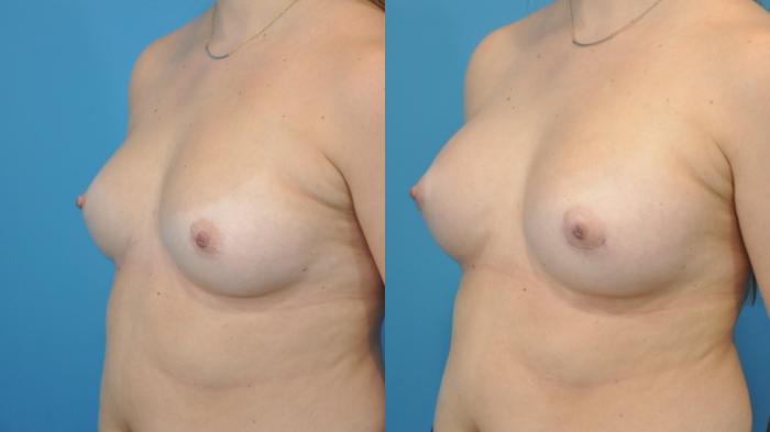 Before & After Breast Augmentation Case 358 Left Oblique View in North Shore, IL