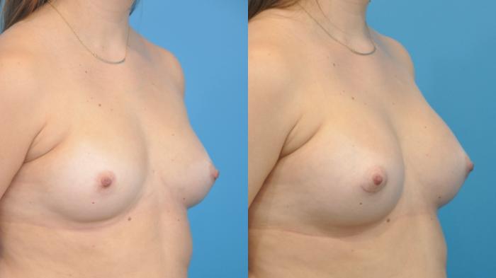 Before & After Breast Augmentation Case 358 Right Oblique View in North Shore, IL