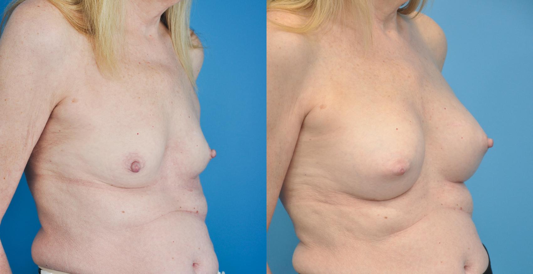 Before & After Breast Augmentation Case 37 View #1 View in North Shore, IL