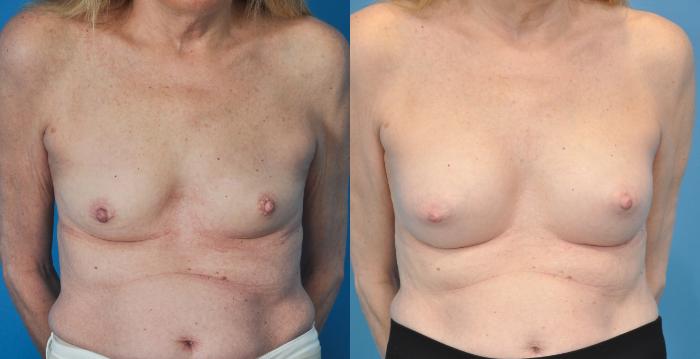 Before & After Breast Augmentation Case 37 View #2 View in Northbrook, IL