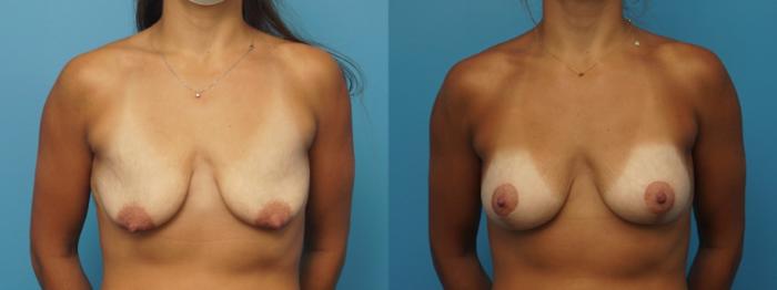 Before & After Breast Augmentation Case 399 Front View in Northbrook, IL