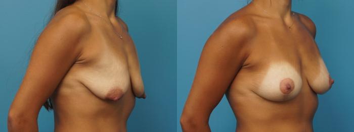 Before & After Breast Augmentation Case 399 Right Oblique View in Northbrook, IL