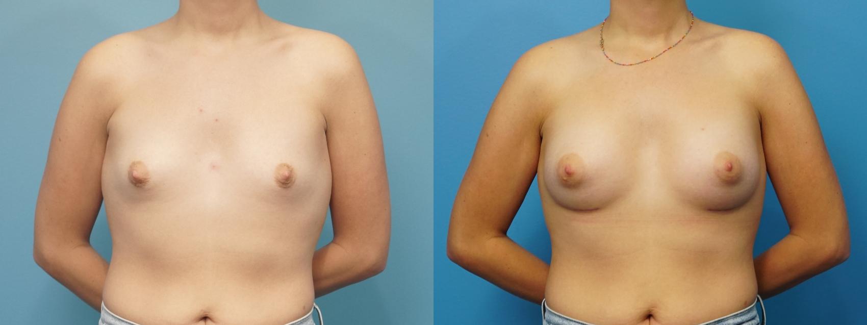 Before & After Breast Augmentation Case 465 Front View in North Shore, IL