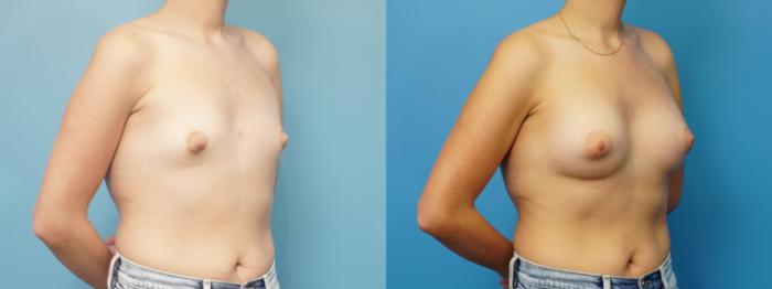 Before & After Breast Augmentation Case 465 Right Oblique View in North Shore, IL