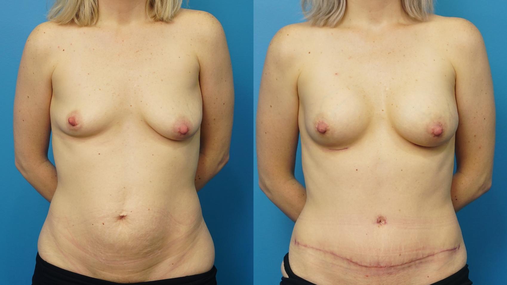 Before & After Breast Augmentation Case 467 Front View in North Shore, IL