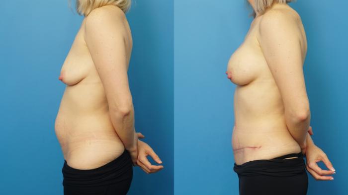 Before & After Breast Augmentation Case 467 Left Side View in North Shore, IL