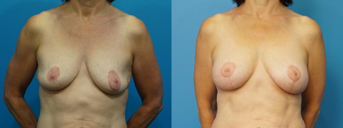 Before & After Breast Augmentation Case 469 Front View in North Shore, IL