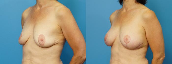 Before & After Revision of Aesthetic Breast Surgery Case 469 Left Oblique View in North Shore, IL