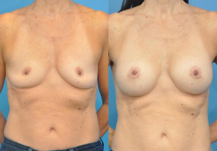 Before & After Breast Augmentation Case 86 View #1 View in Northbrook, IL
