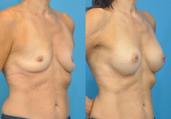 Before & After Breast Augmentation Case 86 View #2 View in North Shore, IL