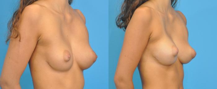Before & After Breast Augmentation Case 87 View #2 View in Northbrook, IL