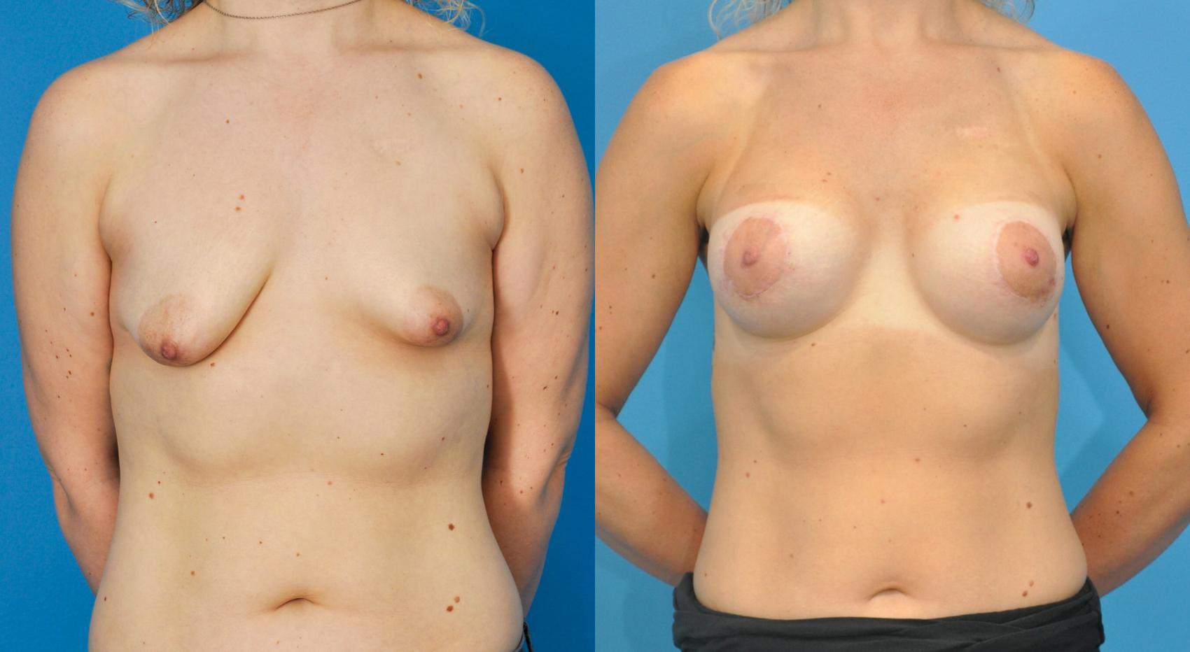 Before & After Breast Augmentation Case 88 View #1 View in North Shore, IL