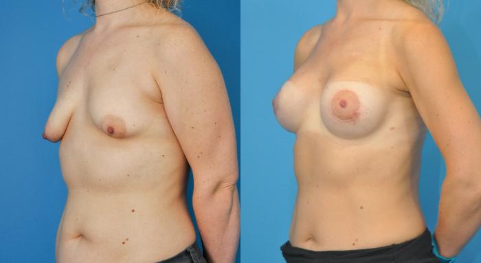 Before & After Breast Augmentation Case 88 View #2 View in Northbrook, IL