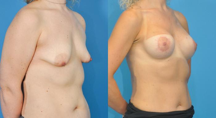 Before & After Breast Augmentation Case 88 View #3 View in Northbrook, IL