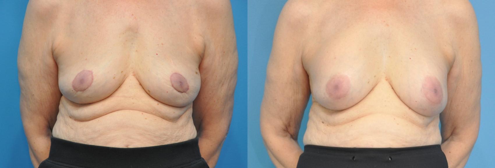Before & After Breast Implant Removal Case 161 View #1 View in Northbrook, IL