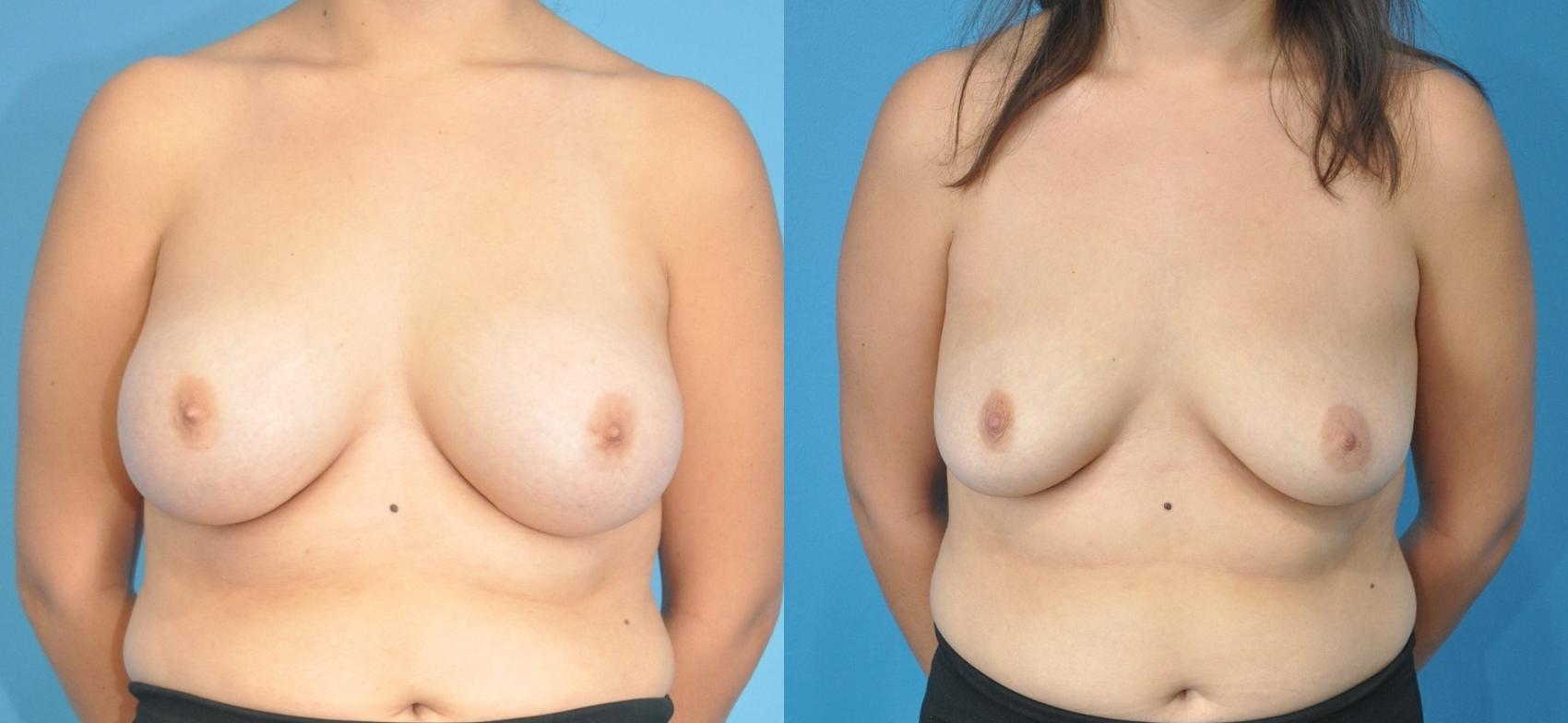 Before & After Breast Implant Removal Case 185 View #1 View in North Shore, IL