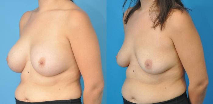 Before & After Breast Implant Removal Case 185 View #2 View in North Shore, IL