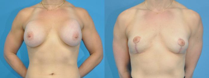 Before & After Breast Implant Removal Case 195 View #1 View in Northbrook, IL
