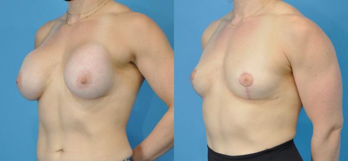 Before & After Breast Implant Removal Case 195 View #2 View in North Shore, IL
