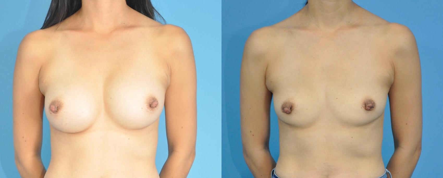 Before & After Breast Implant Removal Case 203 View #1 View in Northbrook, IL