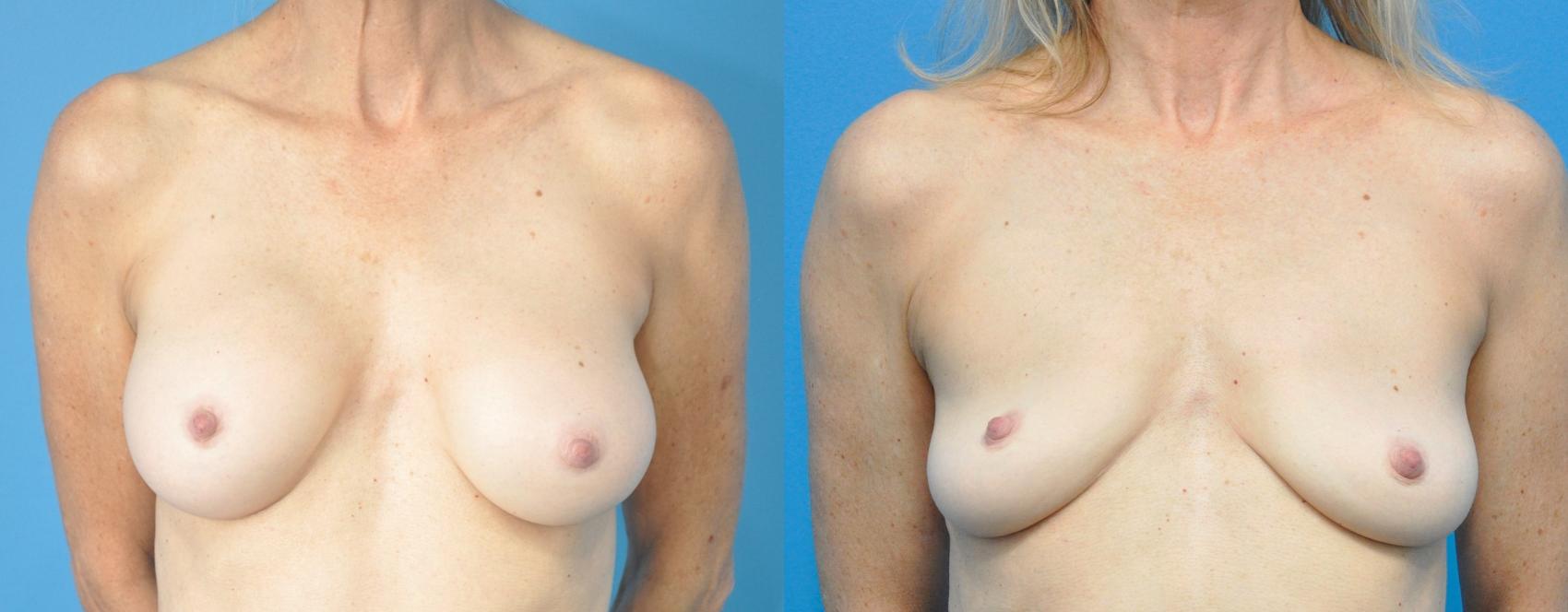 Before & After Breast Implant Removal Case 230 View #1 View in Northbrook, IL