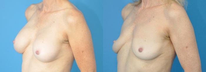 Before & After Breast Implant Removal Case 230 View #2 View in North Shore, IL