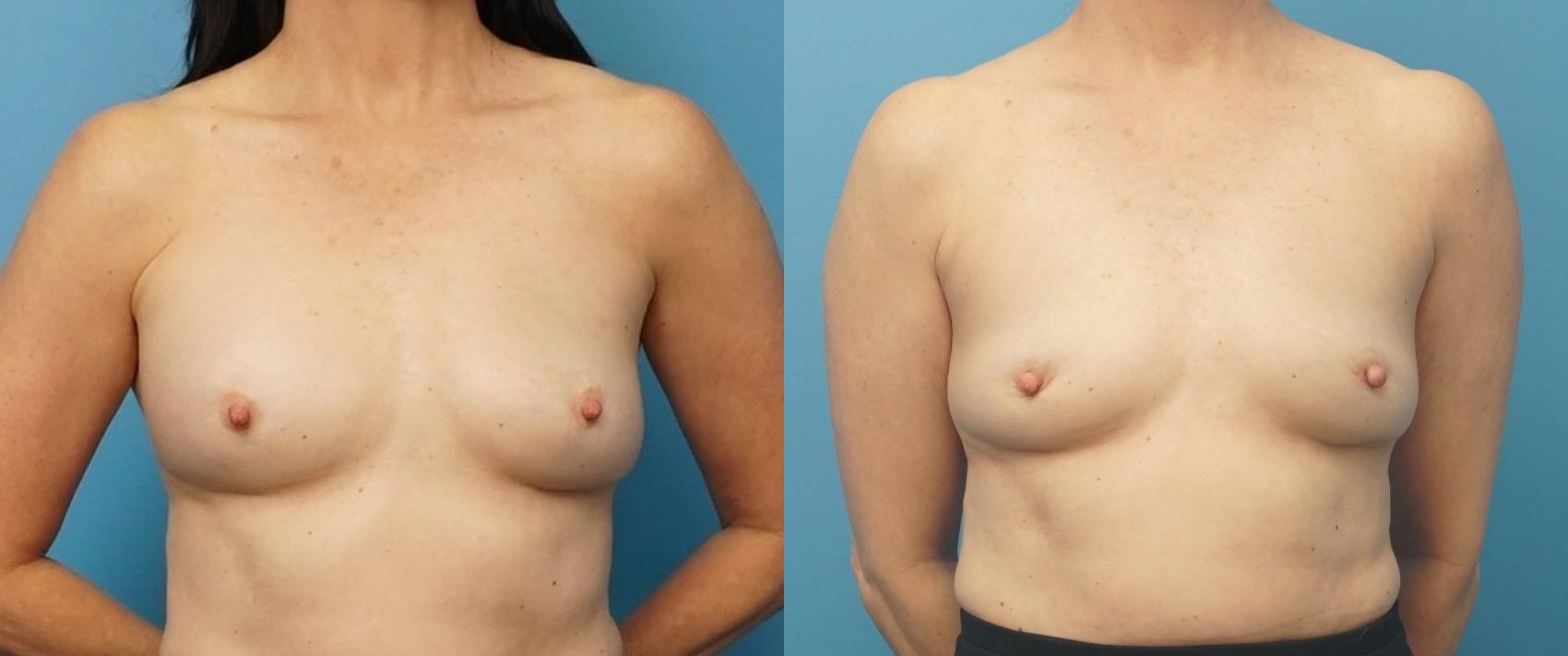Before & After Breast Implant Removal Case 273 Front View in Northbrook, IL