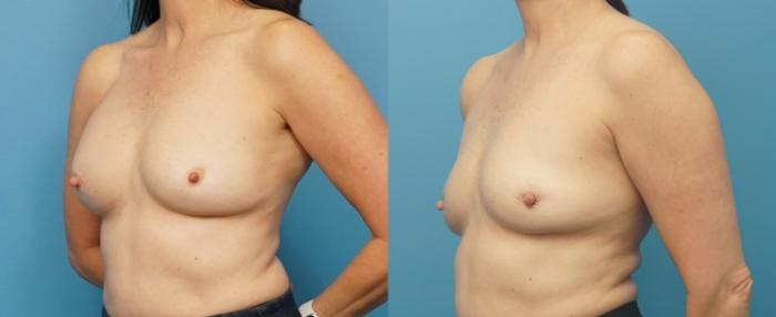 Before & After Breast Implant Removal Case 273 Left Oblique View in North Shore, IL