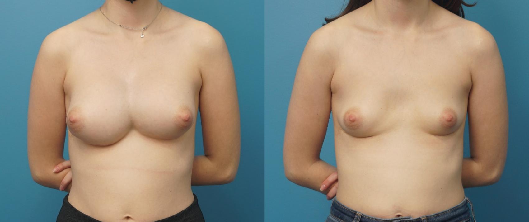 Before & After Breast Implant Removal Case 329 Front View in Northbrook, IL