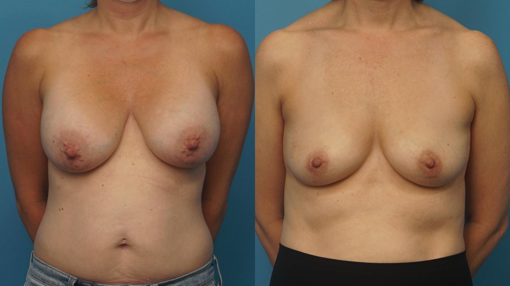 Before & After Breast Implant Removal Case 369 Front View in Northbrook, IL