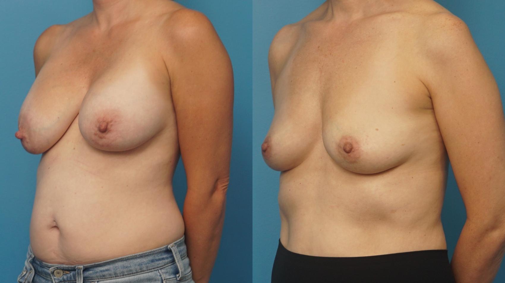 Before & After Breast Implant Removal Case 369 Left Oblique View in Northbrook, IL