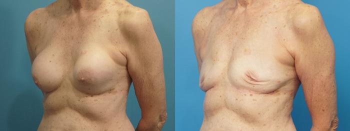 Before & After Breast Implant Removal Case 458 Left Oblique View in North Shore, IL