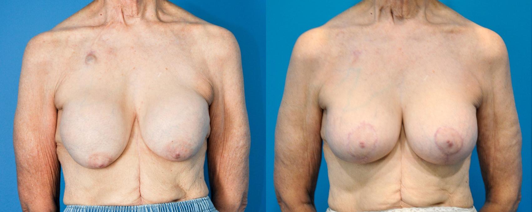 Before & After Breast Lift (Mastopexy) Case 11 View #1 View in Northbrook, IL