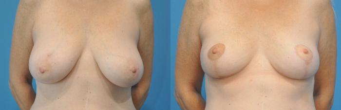 Before & After Breast Lift (Mastopexy) Case 113 View #1 View in North Shore, IL