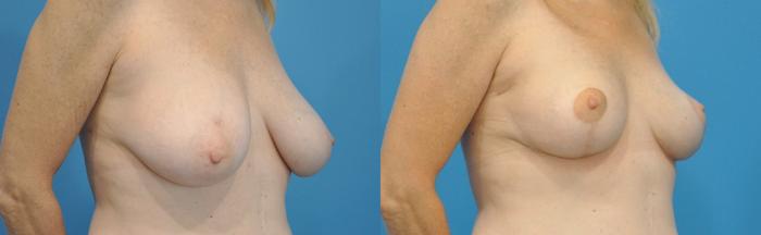 Before & After Breast Lift (Mastopexy) Case 113 View #2 View in North Shore, IL