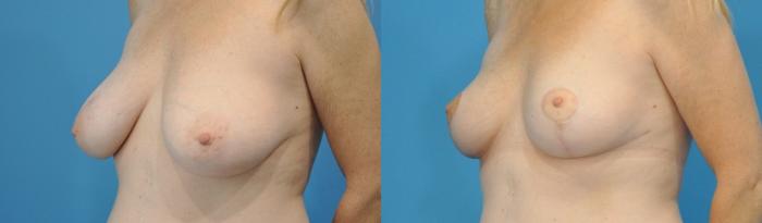 Before & After Breast Lift (Mastopexy) Case 113 View #3 View in North Shore, IL