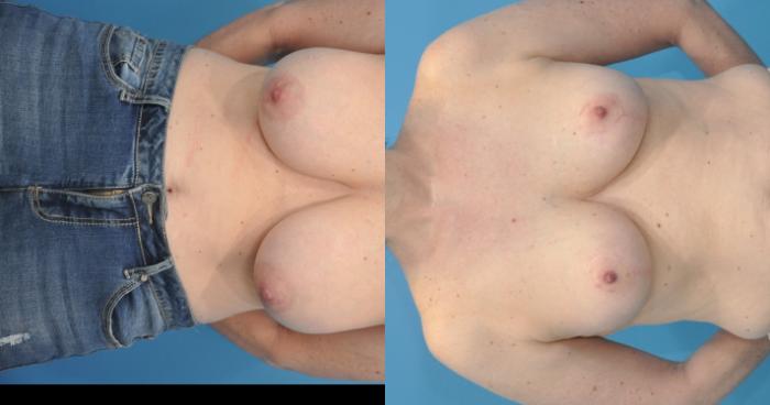 Before & After Breast Lift (Mastopexy) Case 117 View #1 View in North Shore, IL
